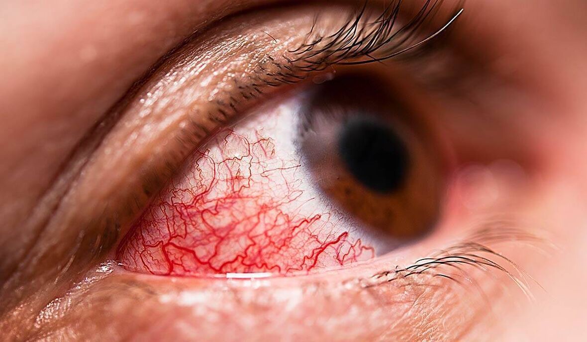 Diabetische Retinopathie ist eine der späten Komplikationen von Diabetes